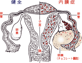 子宮 内 膜 症 漢方 治っ た