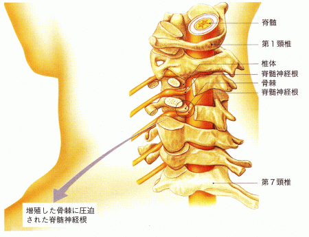 椎体に増殖したとげ状の骨（骨棘）