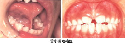 舌小短縮症